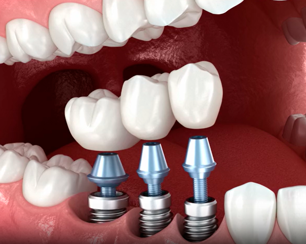 Procedimento de implante dental